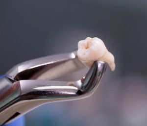 Oral surgery tooth extraction